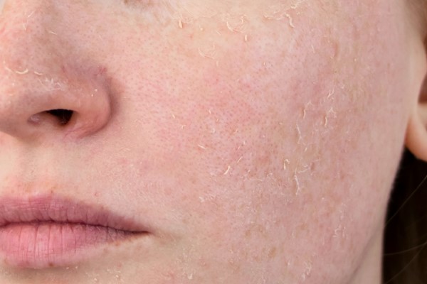 Tác hại của Retinol trên da nếu dùng sai liều lượng